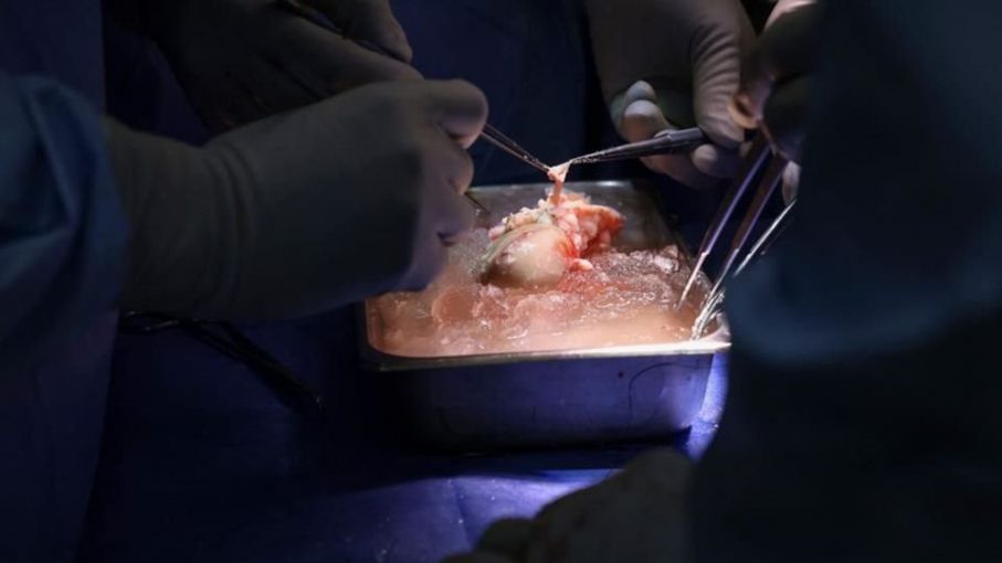 Muere el primer receptor de un trasplante de riñón de cerdo genéticamente modificado